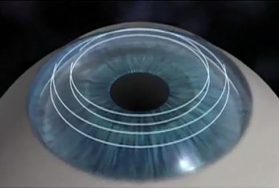 Bladeless Corneal Transplant